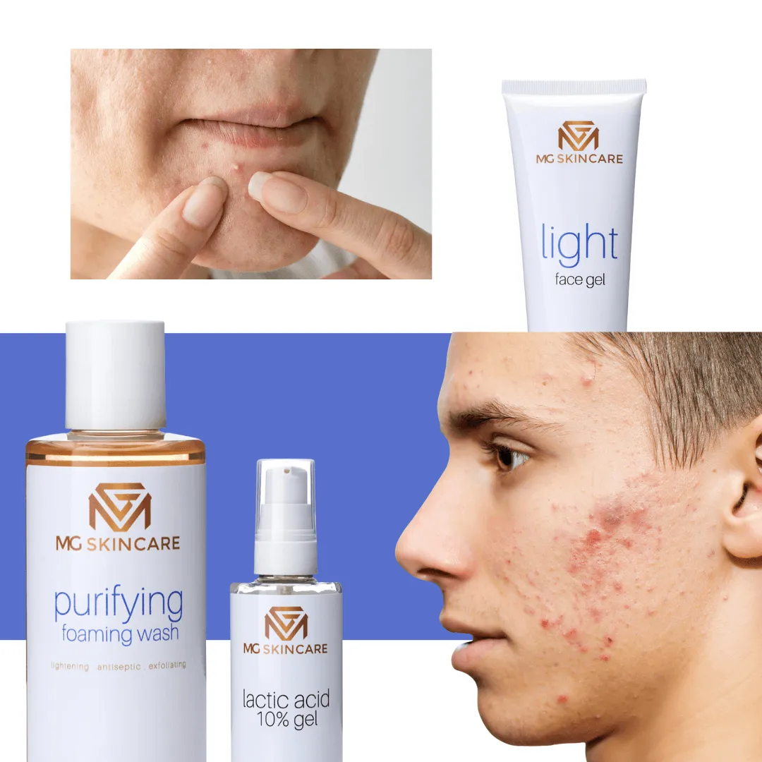 OILY - ACNE - CARE AT HOME